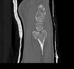 Distal Radius Volar and Dorsal Ulna Fragments